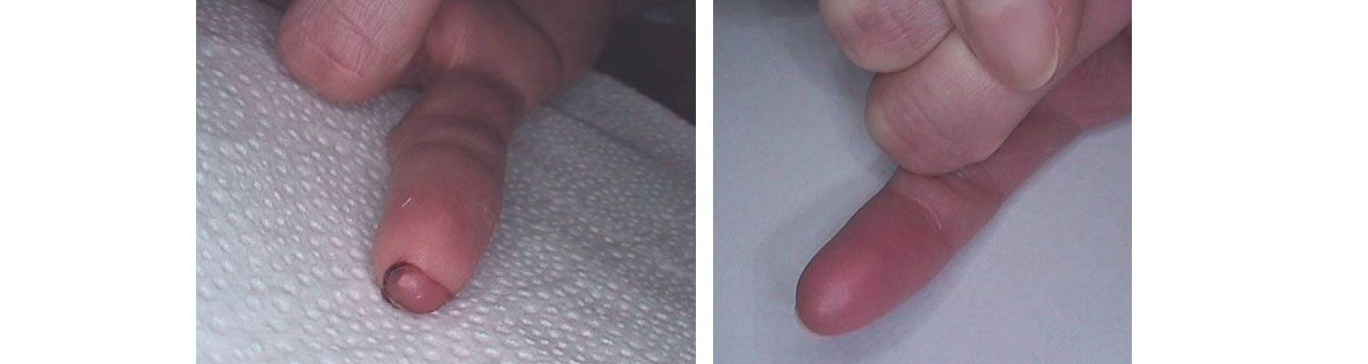 palec przed i po zabiegu led
