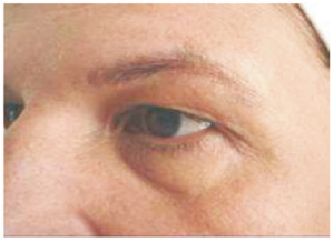 03 karboksyterapia worki pod oczami suwanie cieni pod oczami