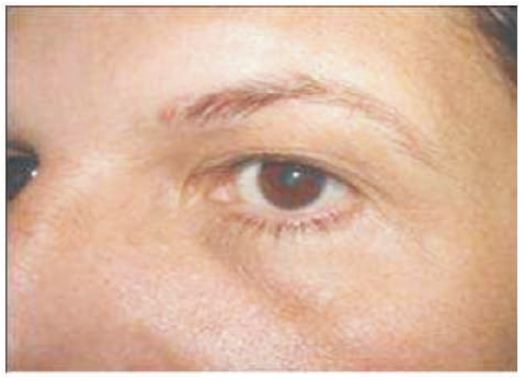 04 karboksyterapia wrocław leczenie worków od oczami