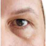 05 karboksyterapia wrocław worki pod oczami leczenie cieni pod oczami
