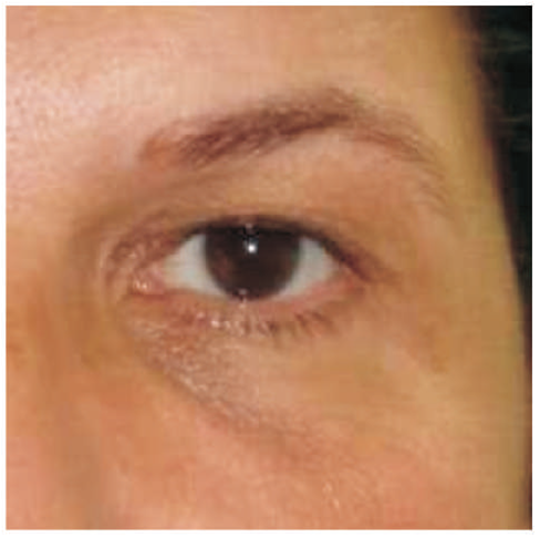 06 karboksyterapia wrocław-worki-pod-oczami-usuwanie-cieni-pod-oczami-6