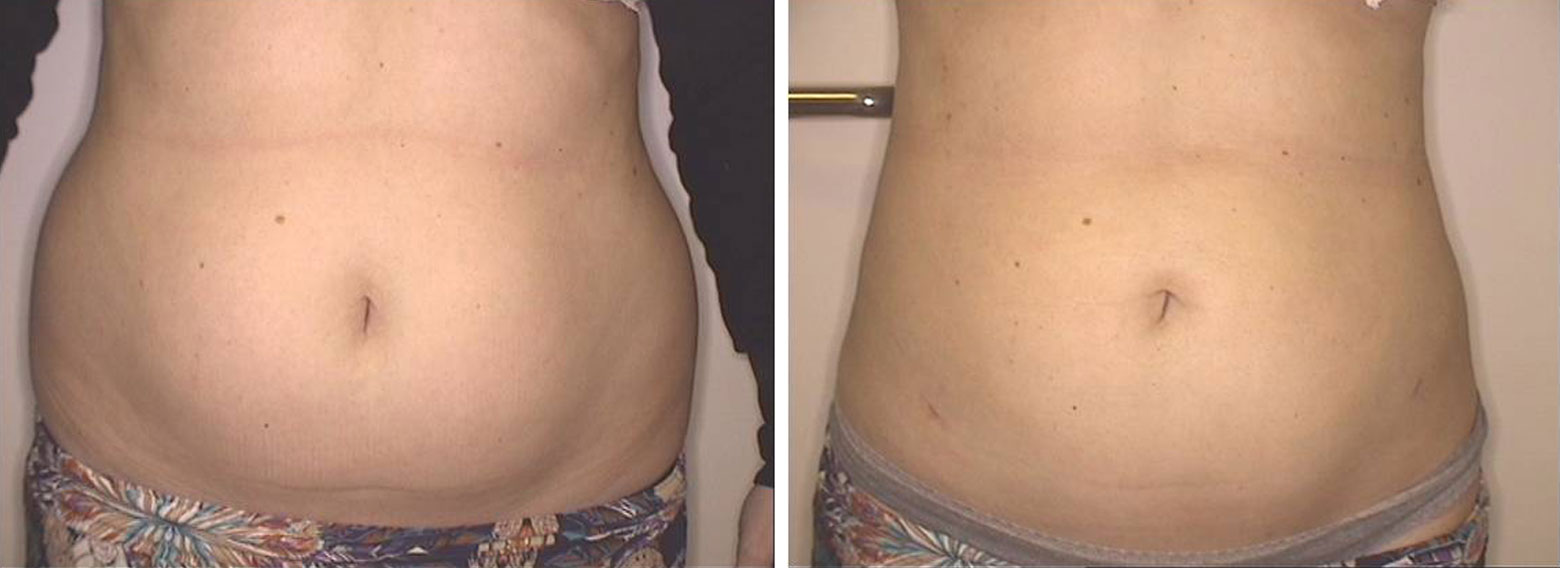 liposukcja wrocław lipo life 3g brzuch przed i po