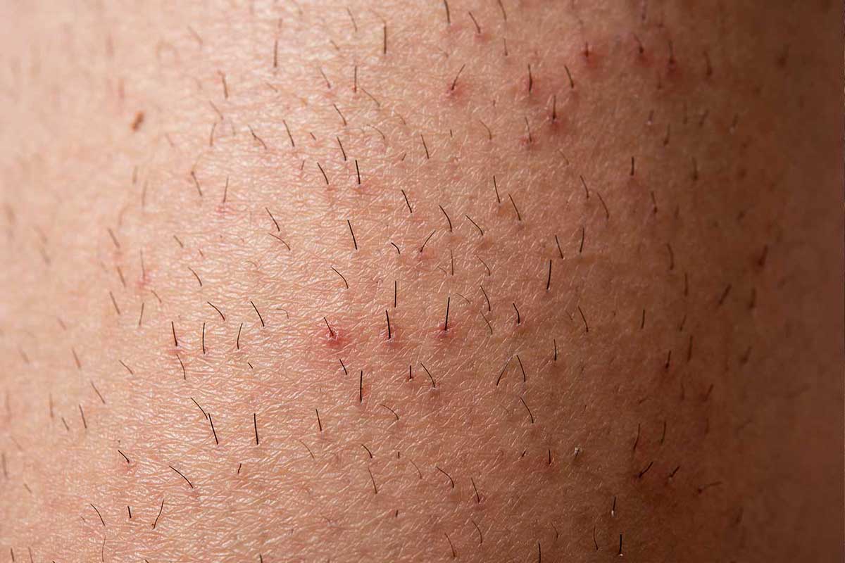 Zapalenie mieszków włosowych na nogach Kaniwoscy Clinic