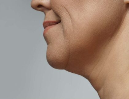 Liposukcja twarzy