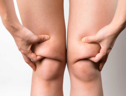 Liposukcja kolan