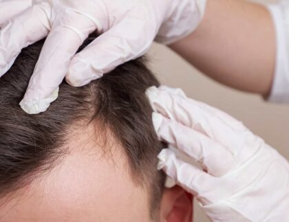 Leczenie wypadania włosów u mężczyzn